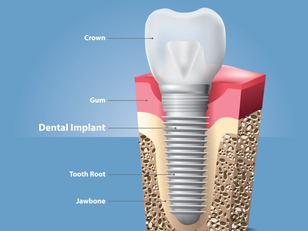 What are dental implants?